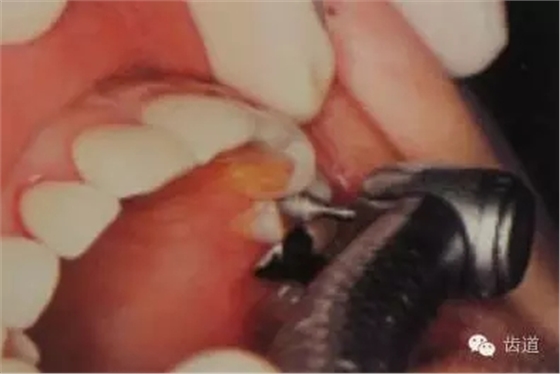 瓷貼面的粘接步驟及技術要點 瓷貼面的粘接步驟及技術要點