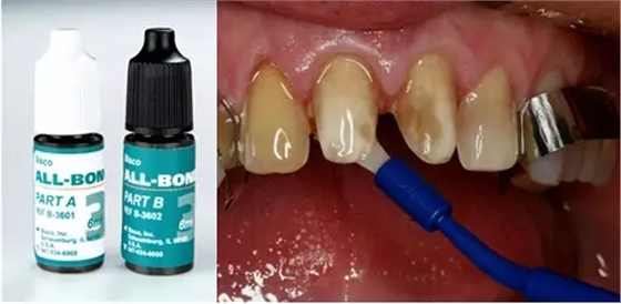 貼面粘接操作流程及要點(diǎn) 貼面粘接操作流程及要點(diǎn)