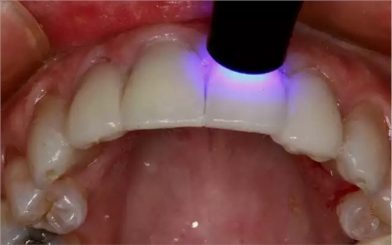 貼面粘接操作流程及要點(diǎn) 貼面粘接操作流程及要點(diǎn)