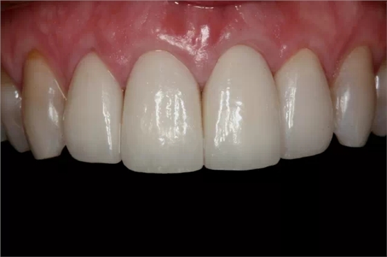 貼面粘接操作流程及要點(diǎn) 貼面粘接操作流程及要點(diǎn)