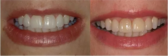 貼面粘接操作流程及要點(diǎn) 貼面粘接操作流程及要點(diǎn)