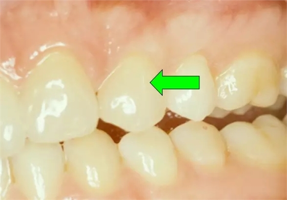 貼面粘接操作流程及要點(diǎn) 貼面粘接操作流程及要點(diǎn)