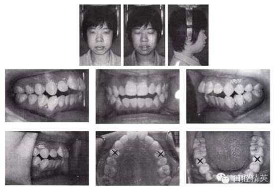 拔牙矯治開(kāi)頜伴前突