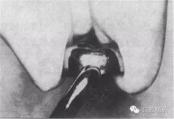 金屬預(yù)成冠修復(fù)-兒童乳牙