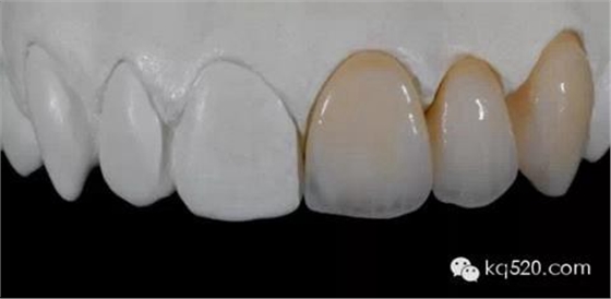 烤瓷牙邊緣變黑，要換新的嗎？