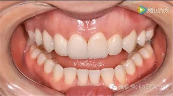 烤瓷牙邊緣變黑，要換新的嗎？