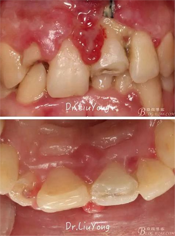 山西牙周劉勇:“前牙外傷患者的口腔多學(xué)科聯(lián)合治療”精彩案例分享 山西牙周劉勇:“前牙外傷患者的口腔多學(xué)科聯(lián)合治療”精彩案例分享