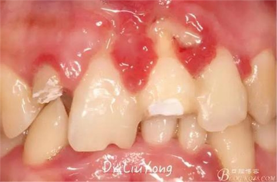 山西牙周劉勇:“前牙外傷患者的口腔多學(xué)科聯(lián)合治療”精彩案例分享 山西牙周劉勇:“前牙外傷患者的口腔多學(xué)科聯(lián)合治療”精彩案例分享