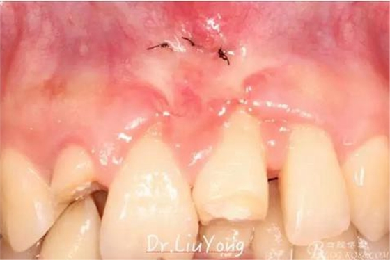 山西牙周劉勇:“前牙外傷患者的口腔多學(xué)科聯(lián)合治療”精彩案例分享 山西牙周劉勇:“前牙外傷患者的口腔多學(xué)科聯(lián)合治療”精彩案例分享