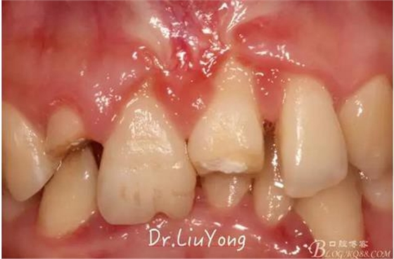 山西牙周劉勇:“前牙外傷患者的口腔多學(xué)科聯(lián)合治療”精彩案例分享 山西牙周劉勇:“前牙外傷患者的口腔多學(xué)科聯(lián)合治療”精彩案例分享