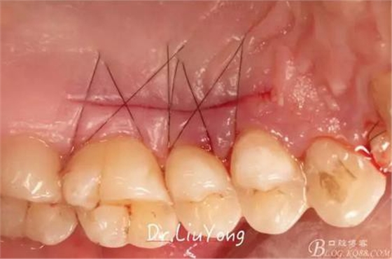 3山西牙周劉勇:“前牙外傷患者的口腔多學(xué)科聯(lián)合治療”精彩案例分享 3山西牙周劉勇:“前牙外傷患者的口腔多學(xué)科聯(lián)合治療”精彩案例分享