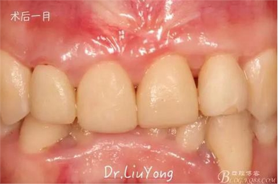 山西牙周劉勇:“前牙外傷患者的口腔多學(xué)科聯(lián)合治療”精彩案例分享 山西牙周劉勇:“前牙外傷患者的口腔多學(xué)科聯(lián)合治療”精彩案例分享