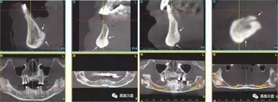 牙醫(yī)引以為戒&mdash;&mdash;日本植牙手術(shù)死亡事件