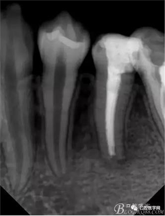 年輕恒牙之根尖誘導(dǎo)術(shù) 年輕恒牙之根尖誘導(dǎo)術(shù)