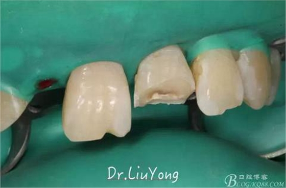 山西牙周劉勇：&ldquo;前牙外傷患者的口腔多學(xué)科聯(lián)合治療&rdquo;精彩案例分享