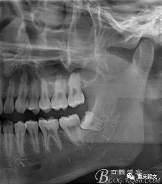 教材版的下頜埋伏智齒的拔除.png 教材版的下頜埋伏智齒的拔除.png