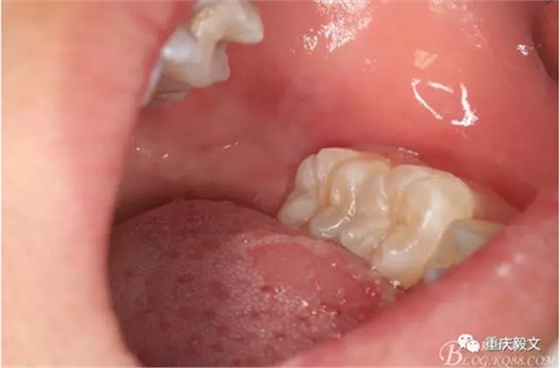 教材版的下頜埋伏智齒的拔除.png 教材版的下頜埋伏智齒的拔除.png