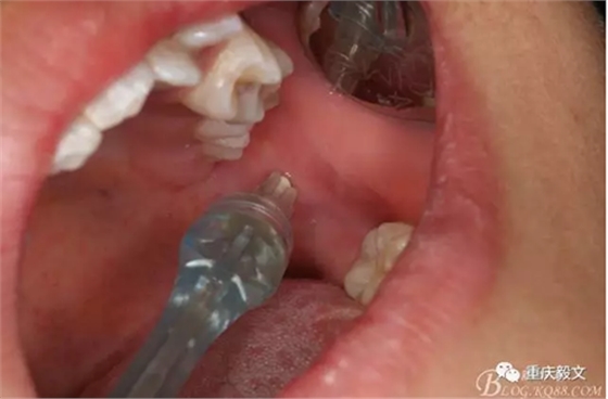 教材版的下頜埋伏智齒的拔除.png 教材版的下頜埋伏智齒的拔除.png