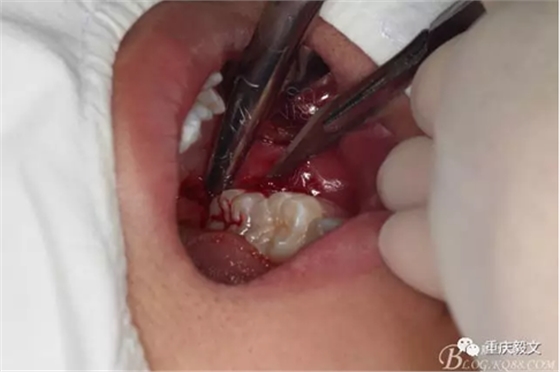 教材版的下頜埋伏智齒的拔除.png 教材版的下頜埋伏智齒的拔除.png