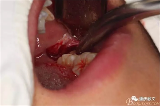 教材版的下頜埋伏智齒的拔除.png 教材版的下頜埋伏智齒的拔除.png