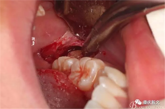 教材版的下頜埋伏智齒的拔除.png 教材版的下頜埋伏智齒的拔除.png