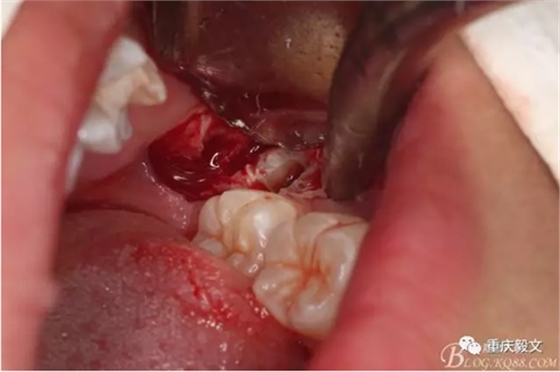 教材版的下頜埋伏智齒的拔除.png 教材版的下頜埋伏智齒的拔除.png