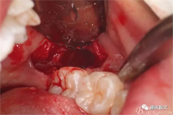 教材版的下頜埋伏智齒的拔除.png 教材版的下頜埋伏智齒的拔除.png