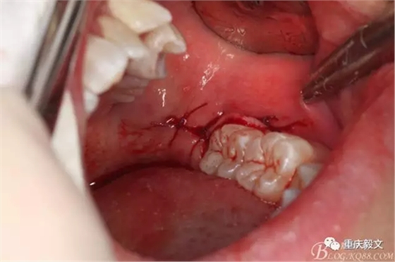 教材版的下頜埋伏智齒的拔除.png 教材版的下頜埋伏智齒的拔除.png