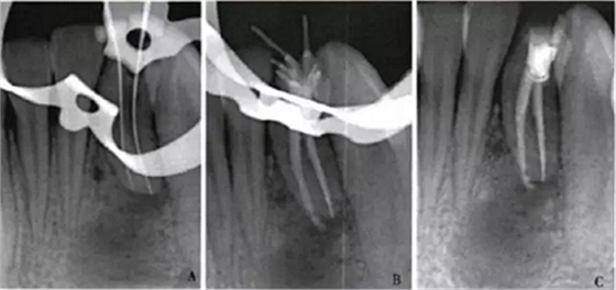 下頜側(cè)切牙Ⅲ型牙內(nèi)陷1例.png 下頜側(cè)切牙Ⅲ型牙內(nèi)陷1例.png