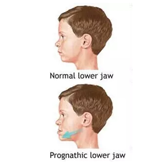 &ldquo;地包天&rdquo;的最佳治療時間