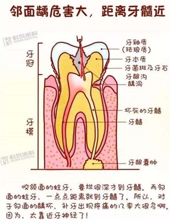 牙縫間的黑線是鄰面齲，還一壞壞倆，巧用它幫你渡過一&ldquo;劫&rdquo;