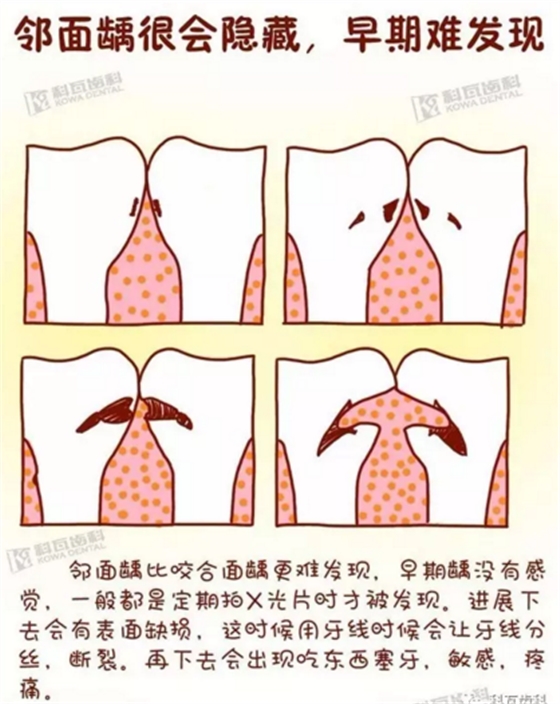 牙縫間的黑線是鄰面齲，還一壞壞倆，巧用它幫你渡過一&ldquo;劫&rdquo;