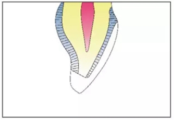 全瓷修復體貼面的制備 全瓷修復體貼面的制備
