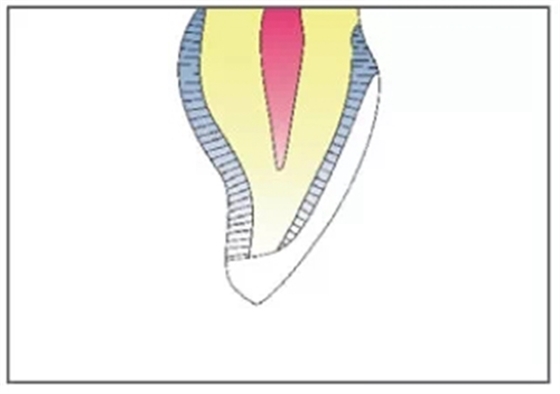 全瓷修復體貼面的制備 全瓷修復體貼面的制備