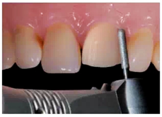 全瓷修復體貼面的制備 全瓷修復體貼面的制備