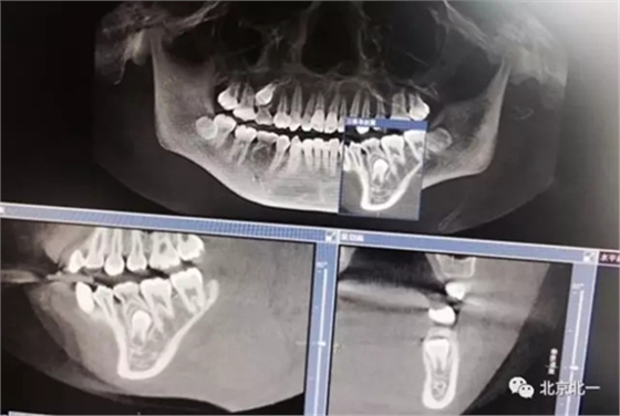 微創(chuàng)舒適拔埋伏牙病 微創(chuàng)舒適拔埋伏牙病