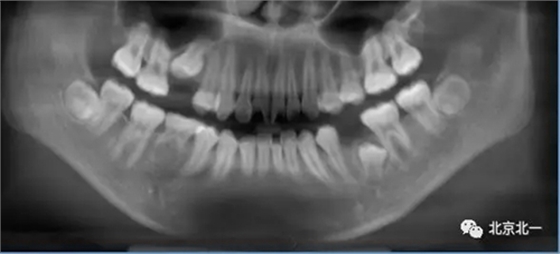微創(chuàng)舒適拔埋伏牙病 微創(chuàng)舒適拔埋伏牙病