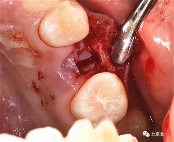 微創(chuàng)舒適拔埋伏牙病 微創(chuàng)舒適拔埋伏牙病