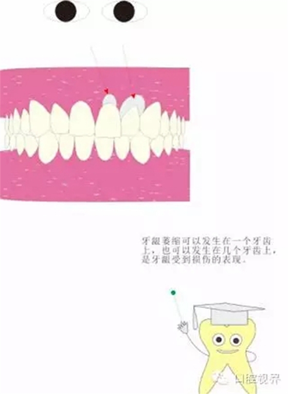 【愛牙科普知識300問】 &ldquo;什么是牙齦萎縮？&rdquo;