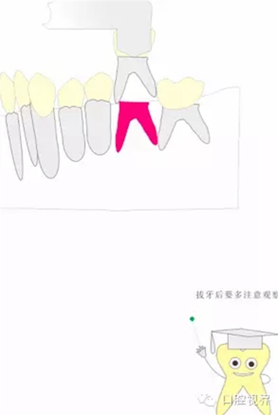 【愛牙科普知識(shí)300問(wèn)】 &ldquo;什么是活髓切斷術(shù)？&rdquo;