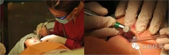 全麻下兒科治療+兒牙樹脂充填 全麻下兒科治療+兒牙樹脂充填