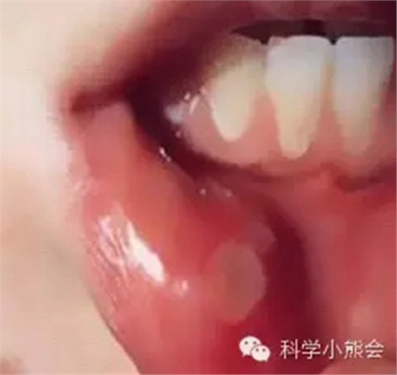 粘液腺囊腫 粘液腺囊腫