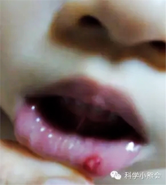 粘液腺囊腫 粘液腺囊腫