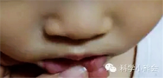 粘液腺囊腫 粘液腺囊腫