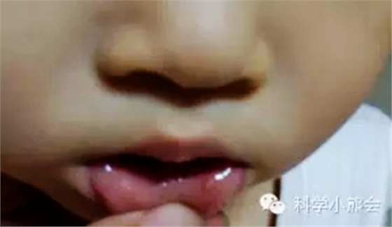 粘液腺囊腫 粘液腺囊腫