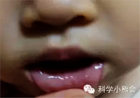 粘液腺囊腫 粘液腺囊腫