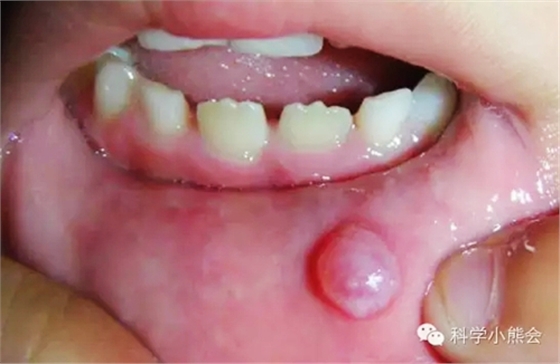 粘液腺囊腫 粘液腺囊腫