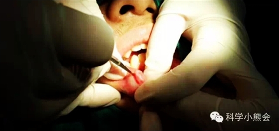 粘液腺囊腫 粘液腺囊腫