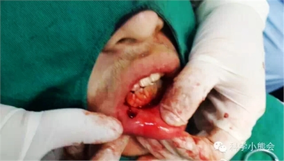 粘液腺囊腫 粘液腺囊腫