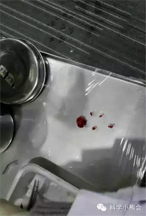 粘液腺囊腫 粘液腺囊腫